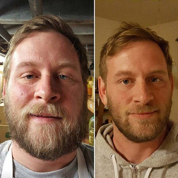 das Aussehen der Person vor und nach dem Aufhören des Alkohols